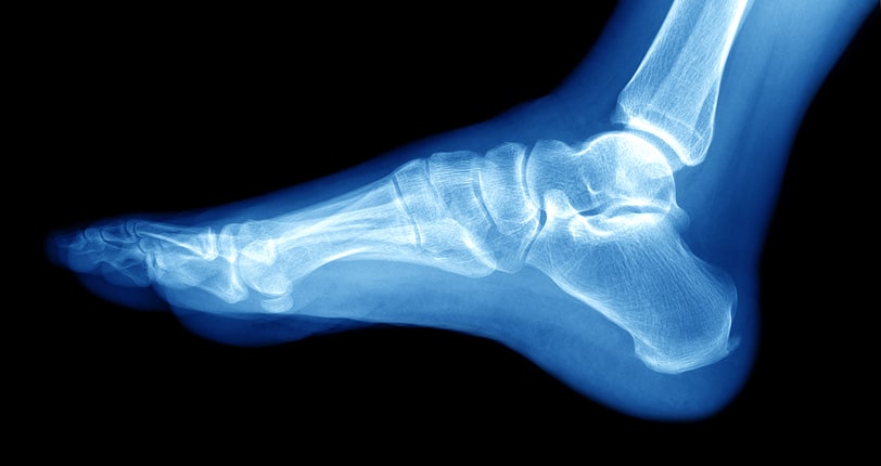 Ankle Sprain vs. Fracture: How are They Different and What are Your