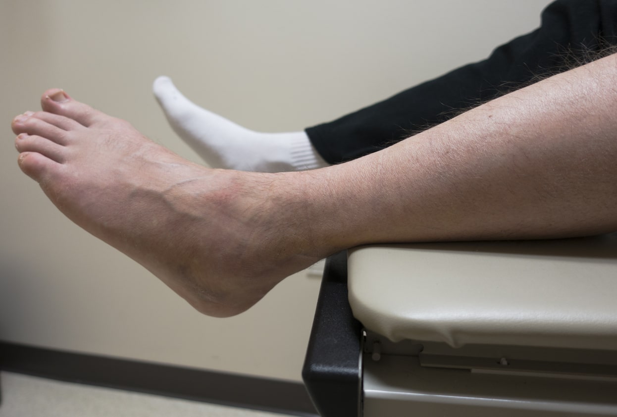 3 of the Most Common Causes of Ankle Pain and Swelling - Cawley