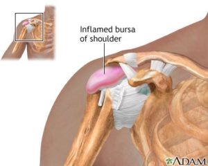 The Painful Effects of Shoulder Bursitis - Cawley Physical Therapy
