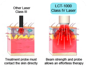 Class IV laser