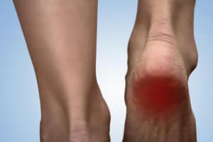 Painful heel with red spot on woman's foot. Arthritis. Tarsal tunnel syndrome concept. Heel pain in women. Pain concept