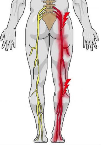 sciatic-nerve - Cawley Physical Therapy