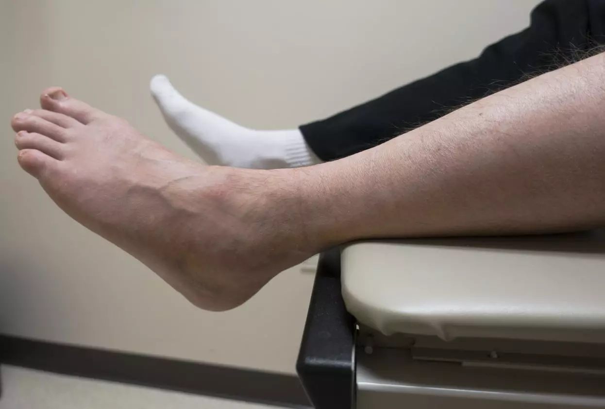 Ankle Pain,Broken Foot, Sprained Ankle, Fractured Bone in Doctor's Exam Room