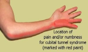Cubital tunnel syndrome
