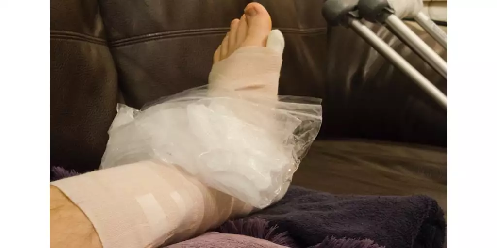 icing injury: broken fractured or sprained foot or ankle in cast