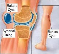 Baker's cyst