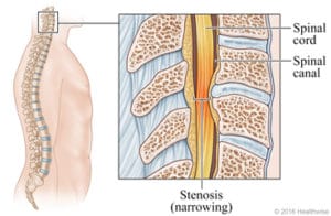 Stenosis graphic