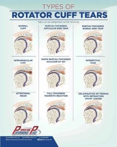 Types of rotator cuff tears