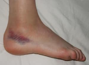 Bruised ankle sprain